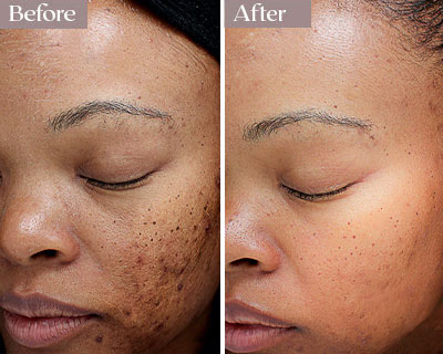 vi peel before after nyc